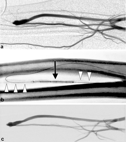 Figure 1 (a) Brachial artery angiogram of the functionally immature radiocephalic fistula