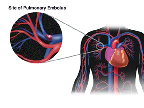 Site of pulmonary embolus