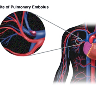 Site of pulmonary embolus