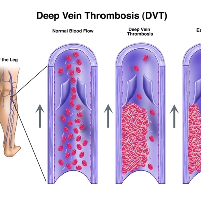 Deep venous disease and blood clots in the vein | Society of ...