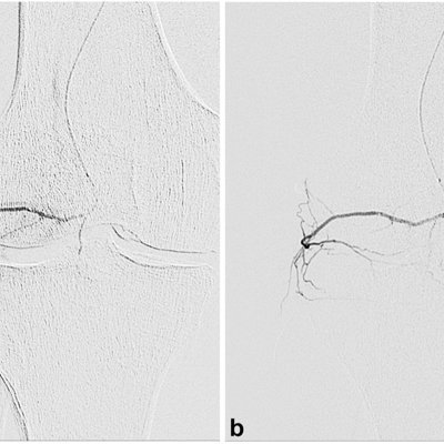Angiograms prepost.jpg