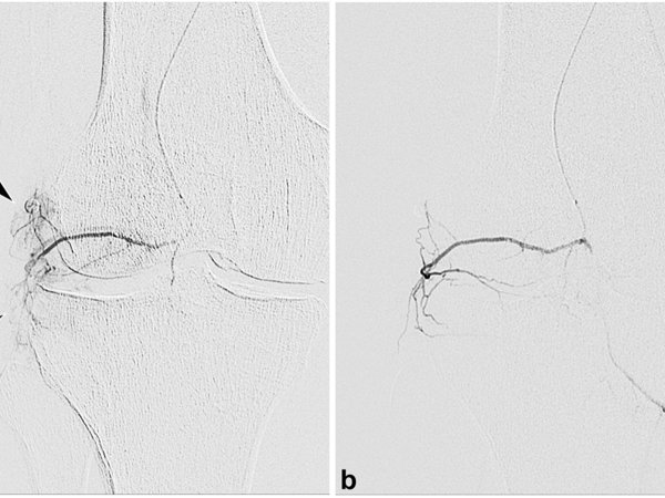 Angiograms prepost.jpg